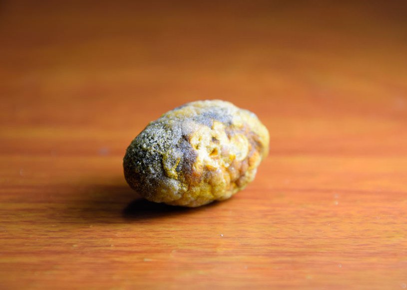 Dieta bogata w tłuszcze skutkuje tworzeniem się kamieni żółciowych /123RF/PICSEL