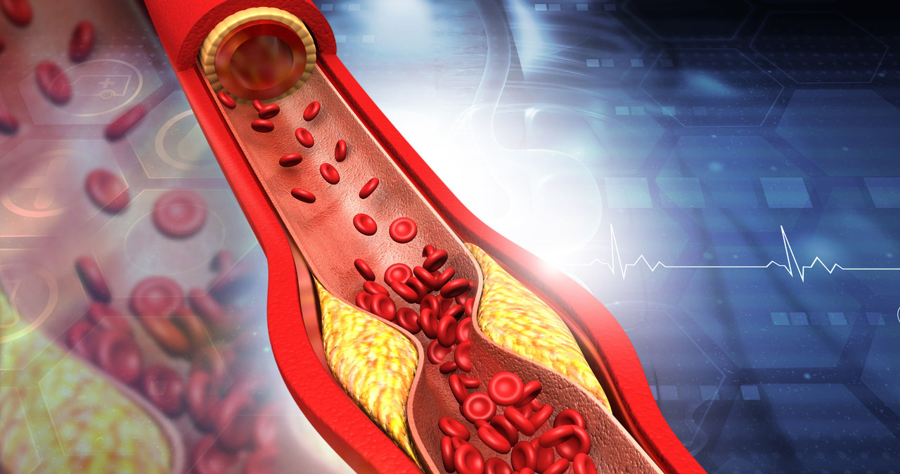 Dieta wysokobiałkowa może prowadzić do rozwoju miażdżycy /123RF/PICSEL