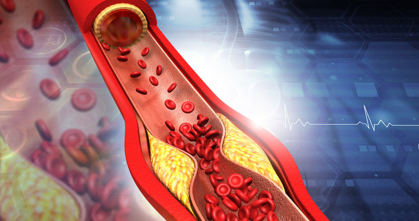 Dlaczego hipercholesterolemia jest tak niebezpieczna? /&copy;123RF/PICSEL