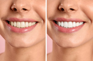 Dlaczego zęby zmieniają kolor? Przyczyna wcale nie taka oczywista