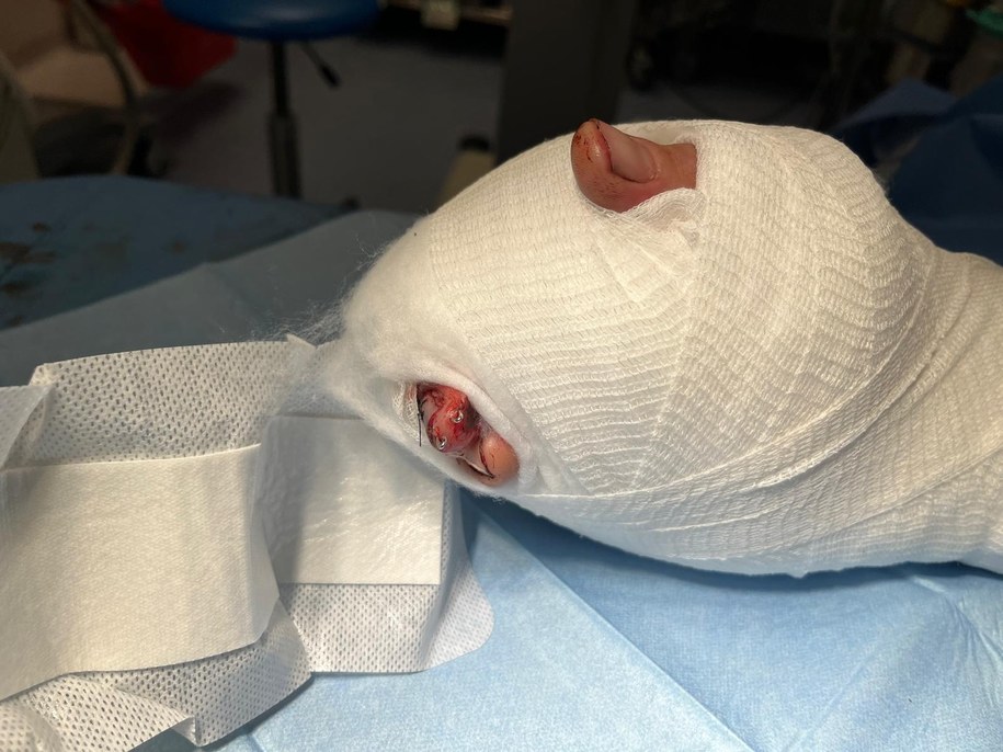 Dłoń po operacji replantacyjnej /Szpital Wojskowy w Krakowie /