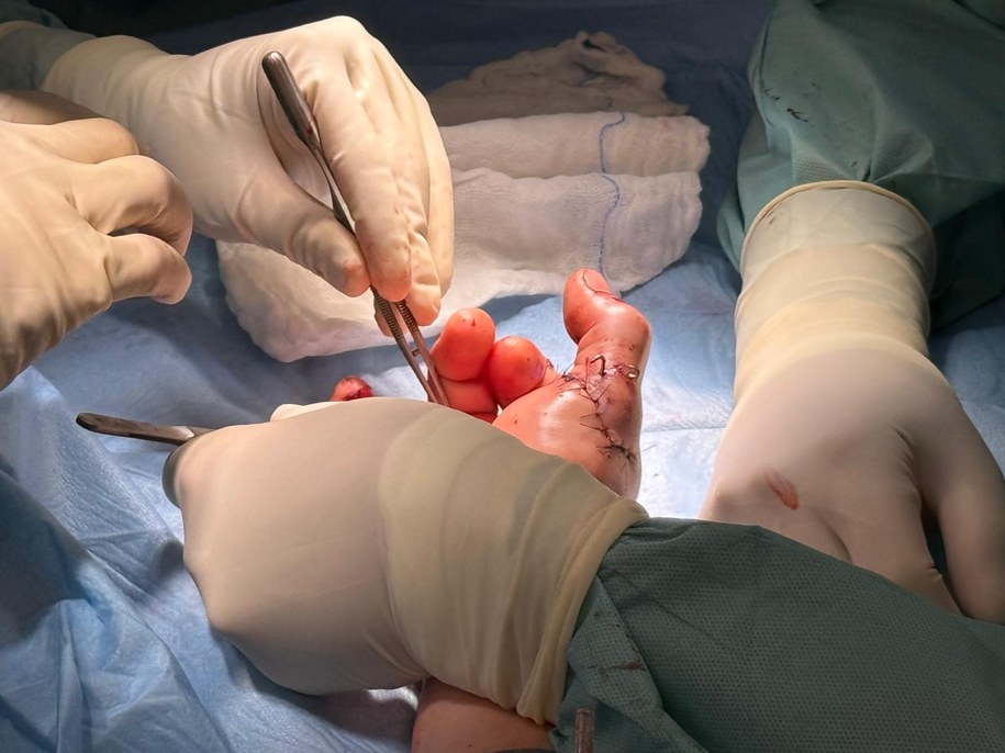 Dłoń po operacji replantacyjnej /Szpital Wojskowy w Krakowie /