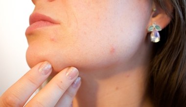 Do jakiego lekarza z trądzikiem hormonalnym?