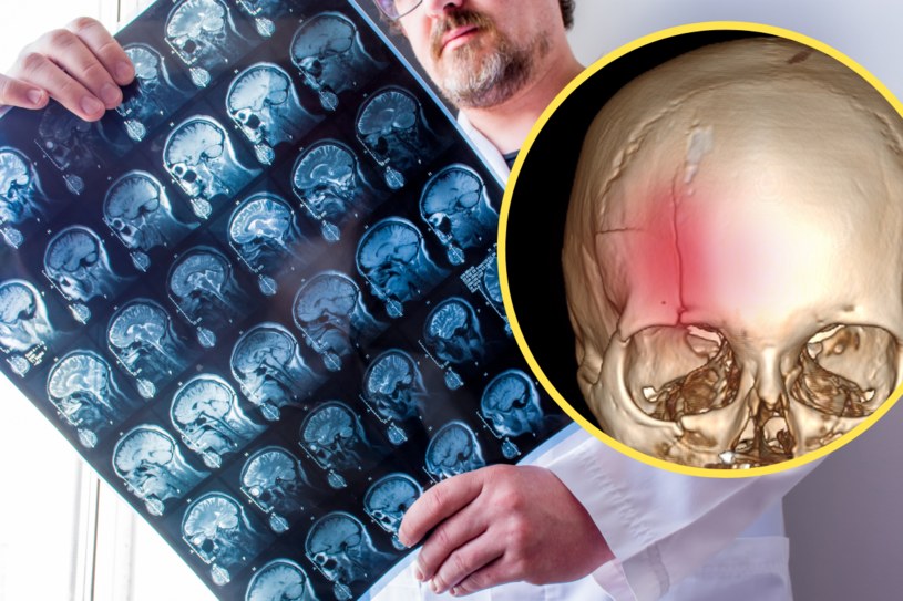 Do uszkodzenia naczyń dochodzi najczęściej pod wpływem ciężkiego uszkodzenia mózgu w wyniku urazów w okolicy głowy i szyi /123RF/PICSEL