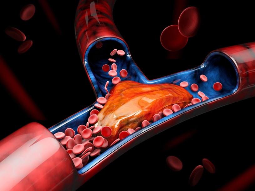 Dobry cholesterol usuwa złogi z tętnic, zapobiegając tym samym miażdżycy /123RF/PICSEL