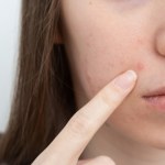 domowe sposoby Domowa mikstura na pryszcze i zaskórniki. Wystarczy wymieszać składniki z kuchni