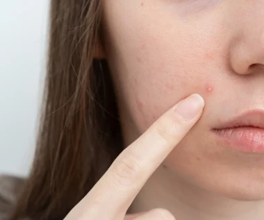 Domowa mikstura na pryszcze i zaskórniki. Wystarczy wymieszać składniki z kuchni