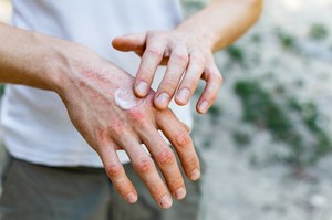 Domowe sposoby na bardzo suche i zniszczone dłonie