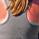 Domowe sposoby na łagodzenie oparzeń słonecznych