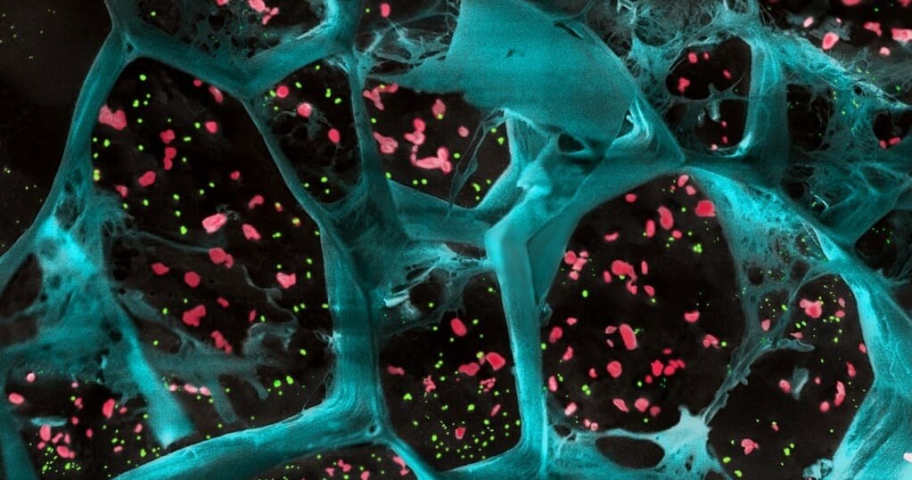 Duże powiększenie hydrożelu (kolor niebieski) zawierającego płytki krwi aktywujące komórki T (kolor czerwony) oraz nanocząstki uwalniające lek hamujący rozwój komórek nowotworowych (kolor zielony). Żel ten hamował wzrost komórek nowotworowych po chirurgicznym usunięciu różnych typów guzów