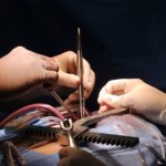 operacja Dwa zabiegi naraz, by uniknąć nowego udaru. Śląski szpital z wyjątkową procedurą