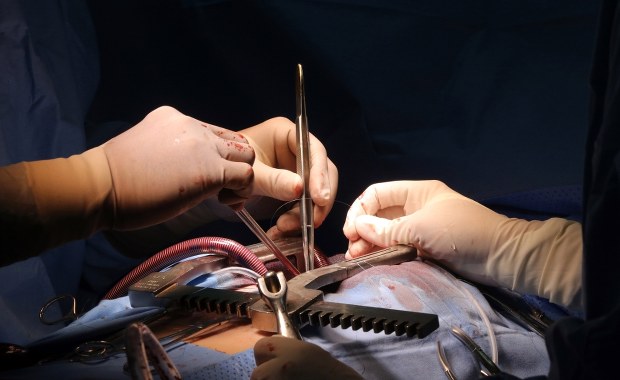 Dwa zabiegi naraz, by uniknąć nowego udaru. Śląski szpital z wyjątkową procedurą