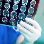 Dwie godziny zamiast tygodni. Nowy test szybko diagnozuje guzy mózgu