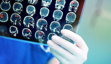 Dwie godziny zamiast tygodni. Nowy test szybko diagnozuje guzy mózgu