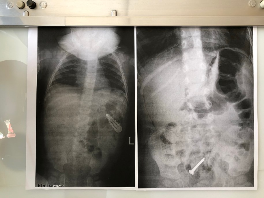 Dzieci połykają nie tylko magnesy /Agnieszka Wyderka /RMF FM