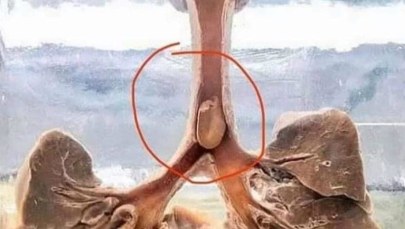 Dziecko zadławiło się orzeszkiem ziemnym. Pielęgniarka publikuje wstrząsające zdjęcie