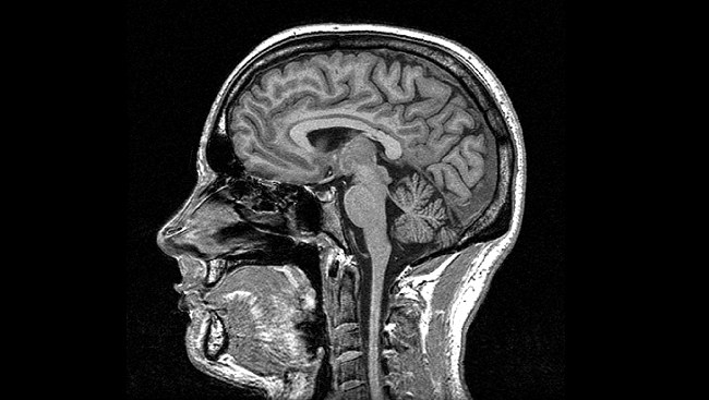 Dzięki badaniom MRI naukowcom udało się na nowo odkryć pionowy pęczek potyliczny /materiały prasowe