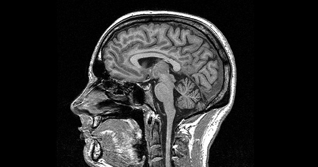 Dzięki badaniom MRI naukowcom udało się na nowo odkryć pionowy pęczek potyliczny /materiały prasowe