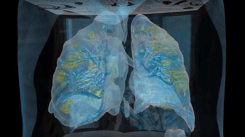 Dzięki VR możemy dokładnie zobaczyć szkody wyrządzane w płucach przez koronawirusa /Geekweek