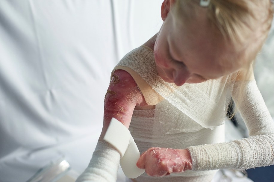 Dziewczynka chorująca na EB /Dominik Kulaszewicz /PAP