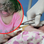 Dziewczynka z syndromem wilkołaka. Pielęgniarka zemdlała na jej widok