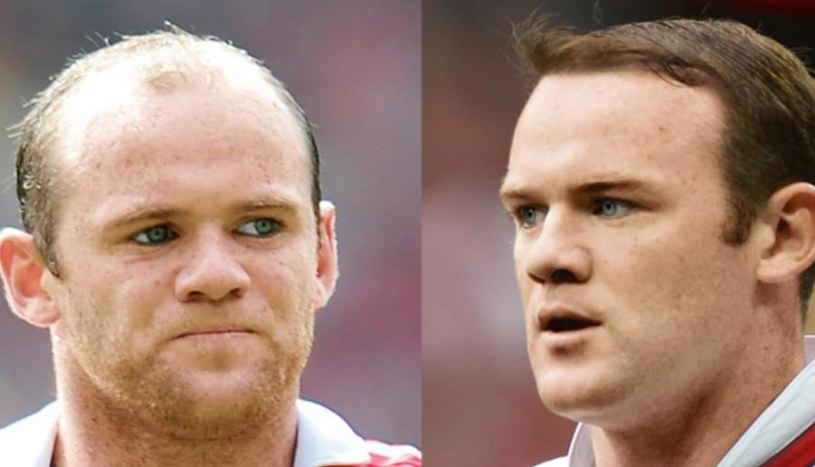 Efekt przeszczepu włosów u Wayne'a Rooney'a /INTERIA.PL/materiały prasowe