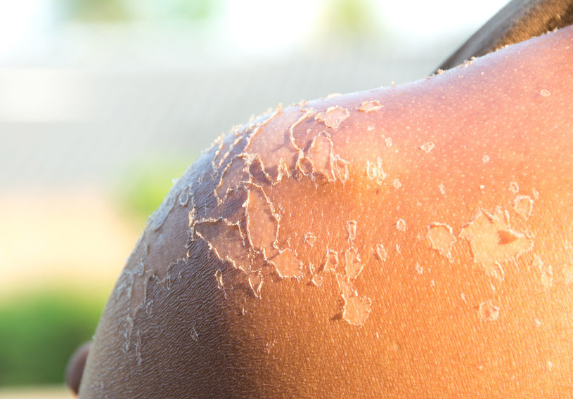 Efektem oparzenia słonecznego będzie łuszcząca się skóra /123RF/PICSEL
