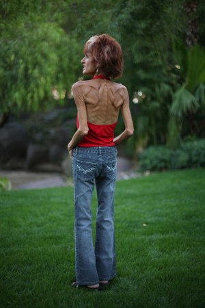 Eksperci twierdzą, że anoreksja może mieć podłoże neurobiologiczne /2008 TIFFANY BROWN/WPN    /PAP/EPA