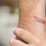 Eksperci wyjaśniają, dlaczego blizny nie znikają i zostają z nami na zawsze