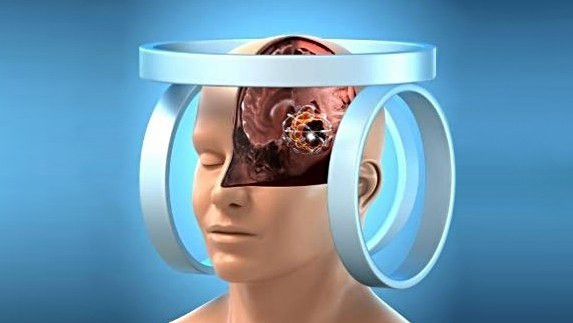 Eksperymentalna terapia może być przydatna szczególnie w przypadku guzów mózgu /materiały prasowe