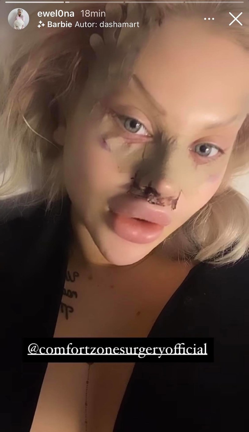 Ewel0na przeszła operację nosa /Screen z InstaStory  /Instagram
