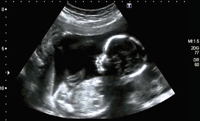 Fetus in fetu to rzadka anomalia, która powstaje podczas bardzo wczesnych stadiów ciąży bliźniaczej /123RF/PICSEL