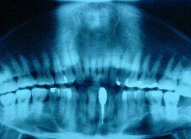 Fotografia rentgenowska zębów, w której dostrzeżono wizerunek Jezusa /MWMedia