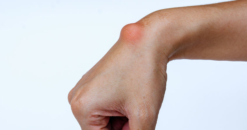 Ganglion /&copy;123RF/PICSEL