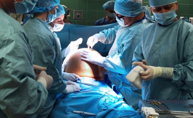 Gigantyczny guz przydatków. Miał 40 cm i ważył ponad 14 kg