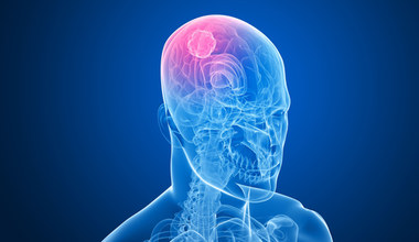 Glejaki - najczęstsze guzy mózgu. Czynniki ryzyka, objawy, leczenie i rokowania