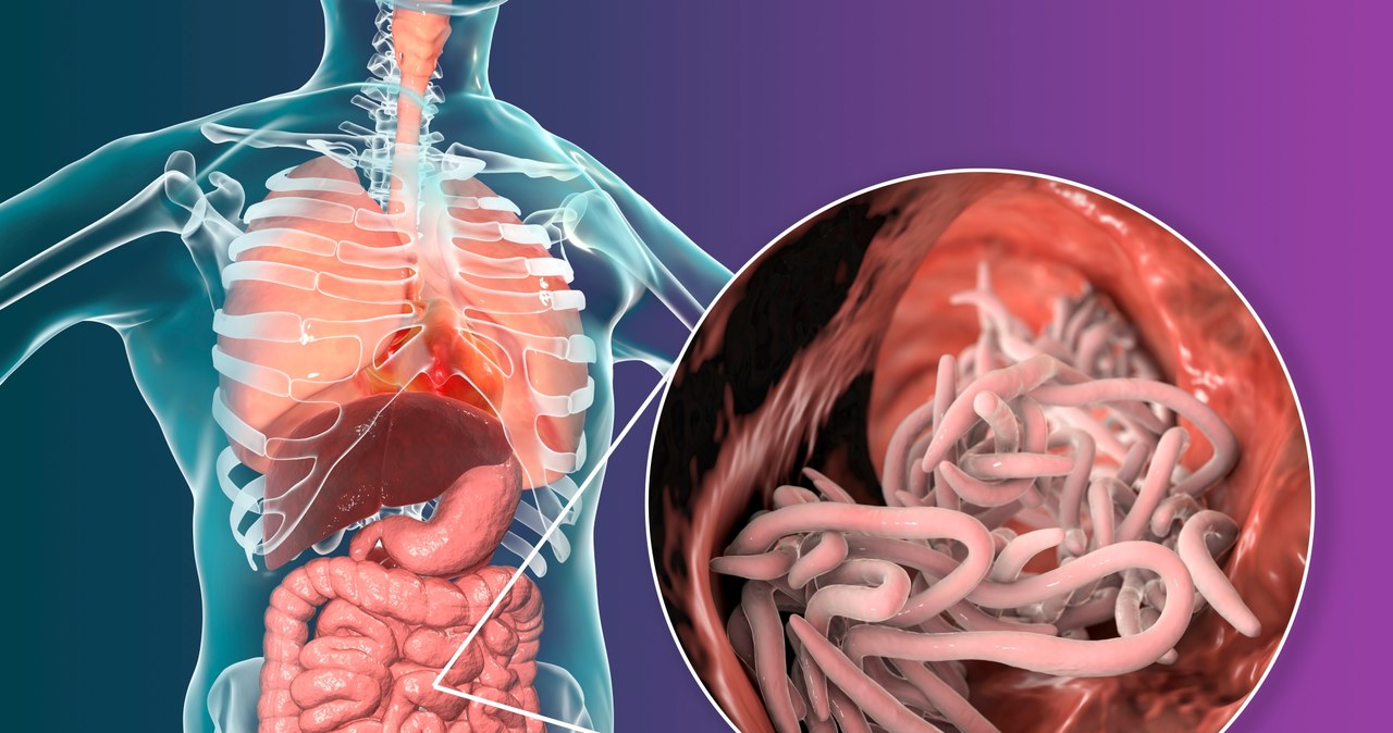 Glista ludzka to popularny pasożyt. Żywi się m.in. cukrem, więc w diecie odrobaczającej organizm trzeba go ograniczyć do minimum /123RF/PICSEL