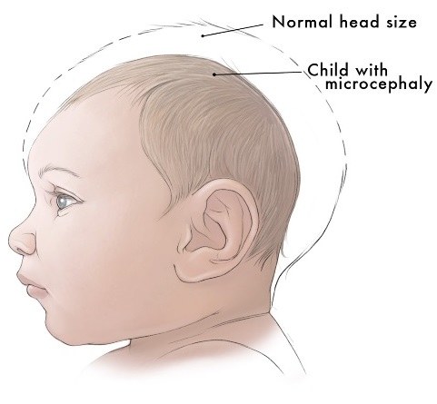 Głowa dziecka z mikrogłowiem (na rysunku) i porównanie, jak wygląda głowa zdrowego niemowlaka /materiały prasowe