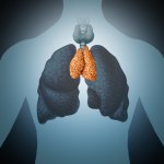 Grasiczak - nowotwór złośliwy grasicy