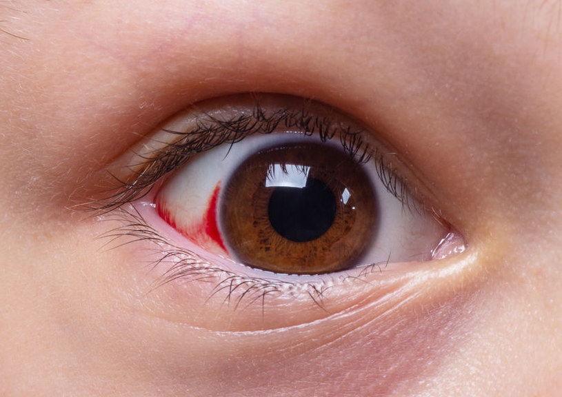 Groźne objawy chorób na oczach /&copy;123RF/PICSEL