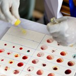 Grupa krwi może wpływać na ryzyko udaru