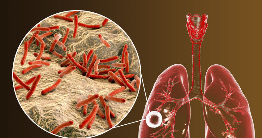 Gruźlica to podstępna choroba /&copy;123RF/PICSEL