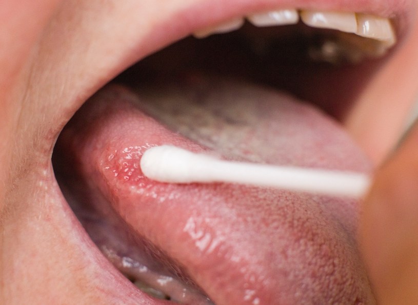 Grzybica jamy ustnej może być wynikiem kilku innych chorób /123RF/PICSEL