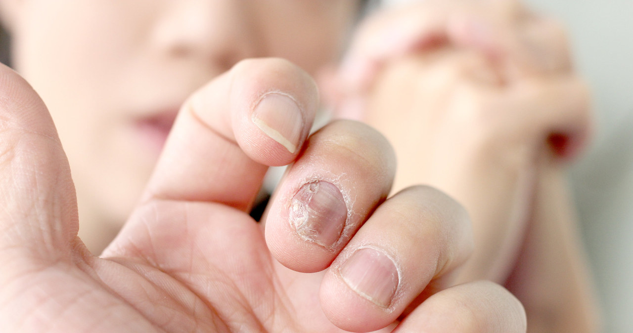 Grzybica paznokci powoduje ich żółto-brązowe zabarwienie i kruchość /123RF/PICSEL