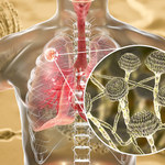 Grzybica płuc: Przyczyny, objawy i leczenie