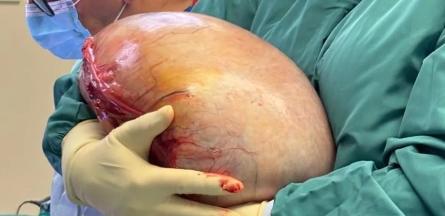 Guz usunięty 23-letniej pacjentce /Szpital Miejski w Zabrzu /