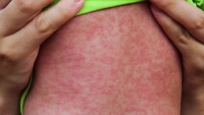 Gwałtowny wzrost zachorowań na odrę w USA