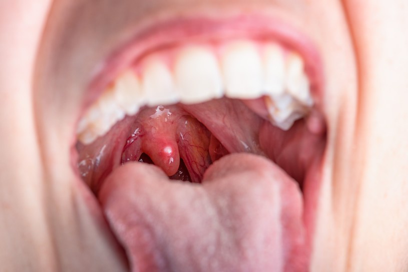 Halitoza może wynikać z zalegających kamieni w migdałkach lub zdradzać chorobę zębów lub dziąseł /123RF/PICSEL