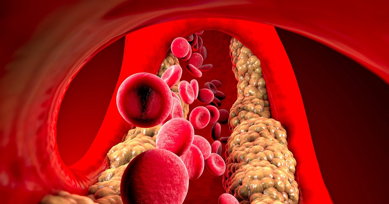 Hipercholesterolemia może wynikać ze złej diety i braku aktywności fizycznej /123RF/PICSEL