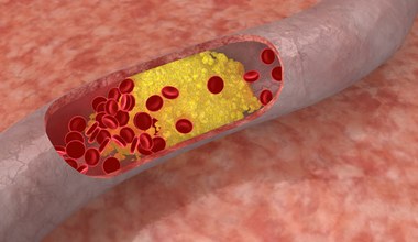 Hipercholesterolemia. Objawy podwyższonego cholesterolu